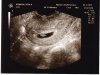 5 неделя беременности: фото живота, УЗИ и вес плода, боли и выделения, ощущения на 5 неделе