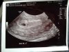 5 неделя беременности: фото живота, УЗИ и вес плода, боли и выделения, ощущения на 5 неделе