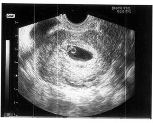 УЗИ на первом месяце беременности