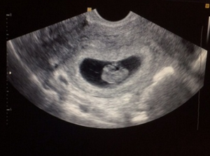 Второй месяц беременности фото