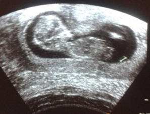 Беременность на третьем месяце фото