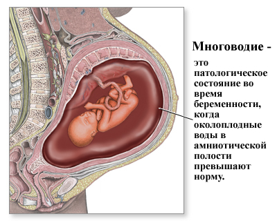 Многоводие при беременности, умеренное многоводие при беременности