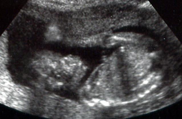 Сколько будет 19 недель. УЗИ 19 недель беременности. Снимок УЗИ на 19 неделе беременности.