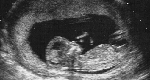 Фото узи девочки на 13 неделе беременности