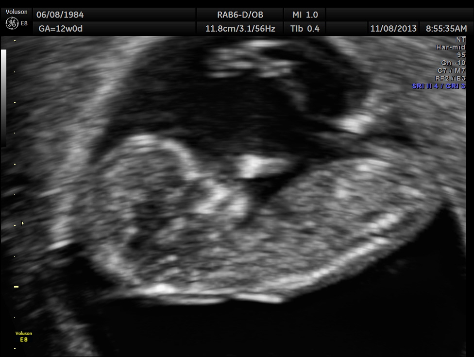 13 неделя коричневые. УЗИ 12-13 недель беременности. Снимок УЗИ 13 недель. Узии на 13 неделе беременности.