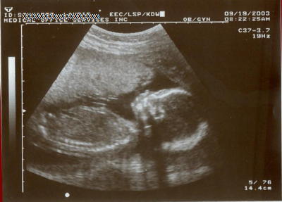 В 20 недель голова. УЗИ 20 недель беременности. Ребенок на 20 неделе беременности УЗИ. 20 Недель беременности фото. УЗИ 19 недель беременности.