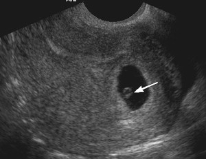 Узи 6 месяцев. 6 Недель беременности фото. Живот на 6 недели беременности фото эмбриона. Беременность 6 недель фото эмбриона. Как выглядит эмбрион в 6 недель беременности фото.
