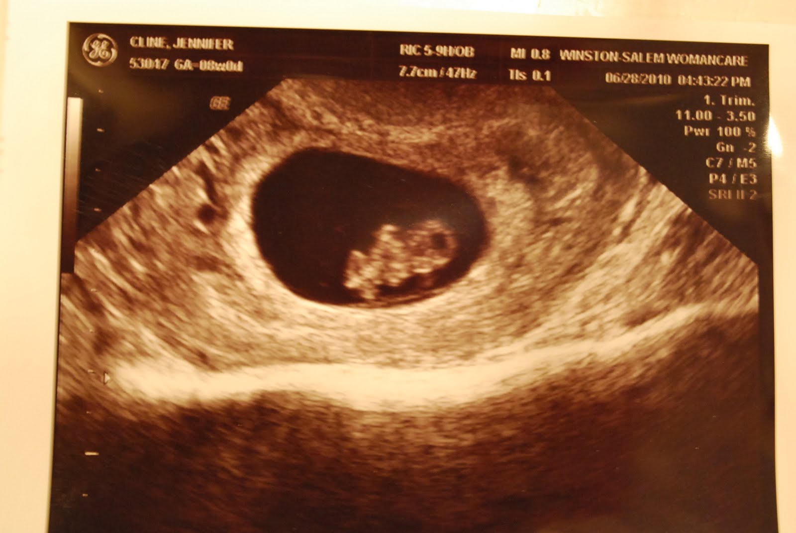 Эмбрион 8 недель УЗИ