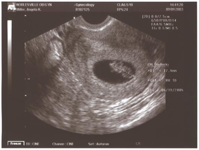 Беременность 7 8 недель фото эмбриона на узи