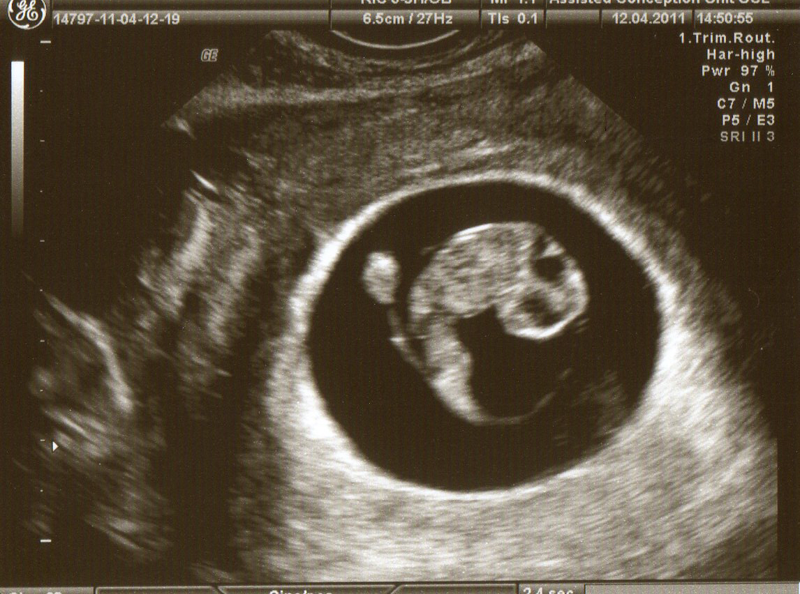 Фото эмбриона на 8 неделе