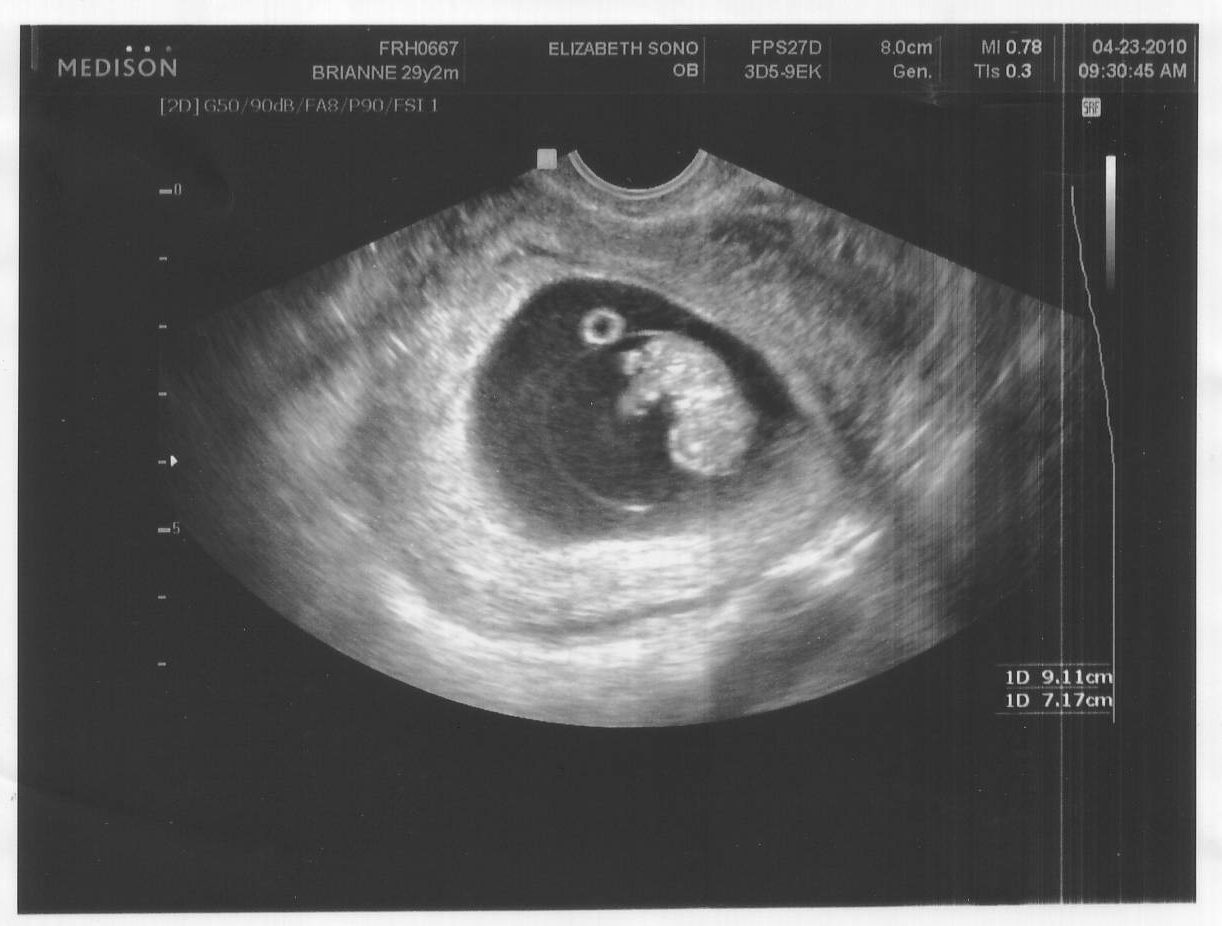 Конец 9 недели. УЗИ 8-9 недель беременности. Плод на 8 неделе беременности УЗИ. 9 Недель 5 дней беременность фото УЗИ. УЗИ на 8 неделе беременности акушерской.
