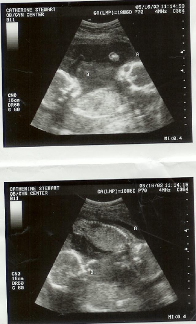Узи 40 недель. Снимки УЗИ. УЗИ на 40 неделе беременности. УЗИ на 35 неделе беременности. Снимок УЗИ беременности 40 недель.