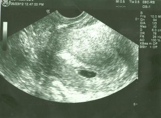 Фото узи на 4 недели беременности фото плода на узи