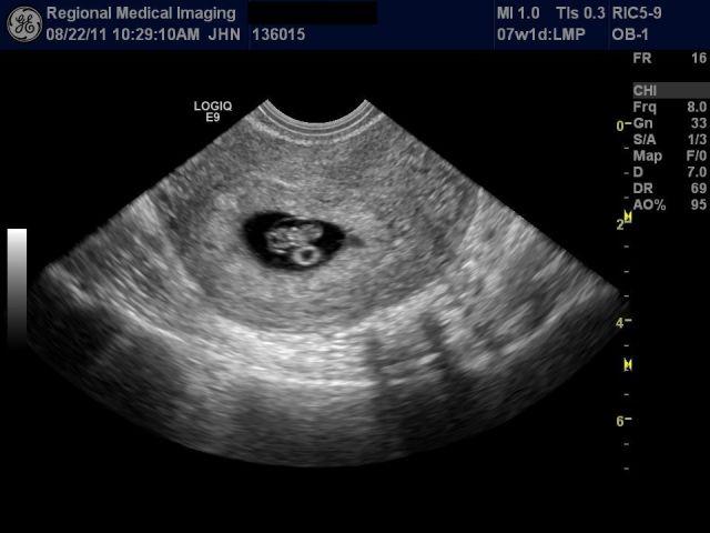 Как выглядит узи на 6 неделе. УЗИ 6.6 недель беременности фото. Фото эмбриона на 6 неделе беременности на УЗИ. 6 Акушерских недель беременности на УЗИ. УЗИ 6-7 недель беременности.