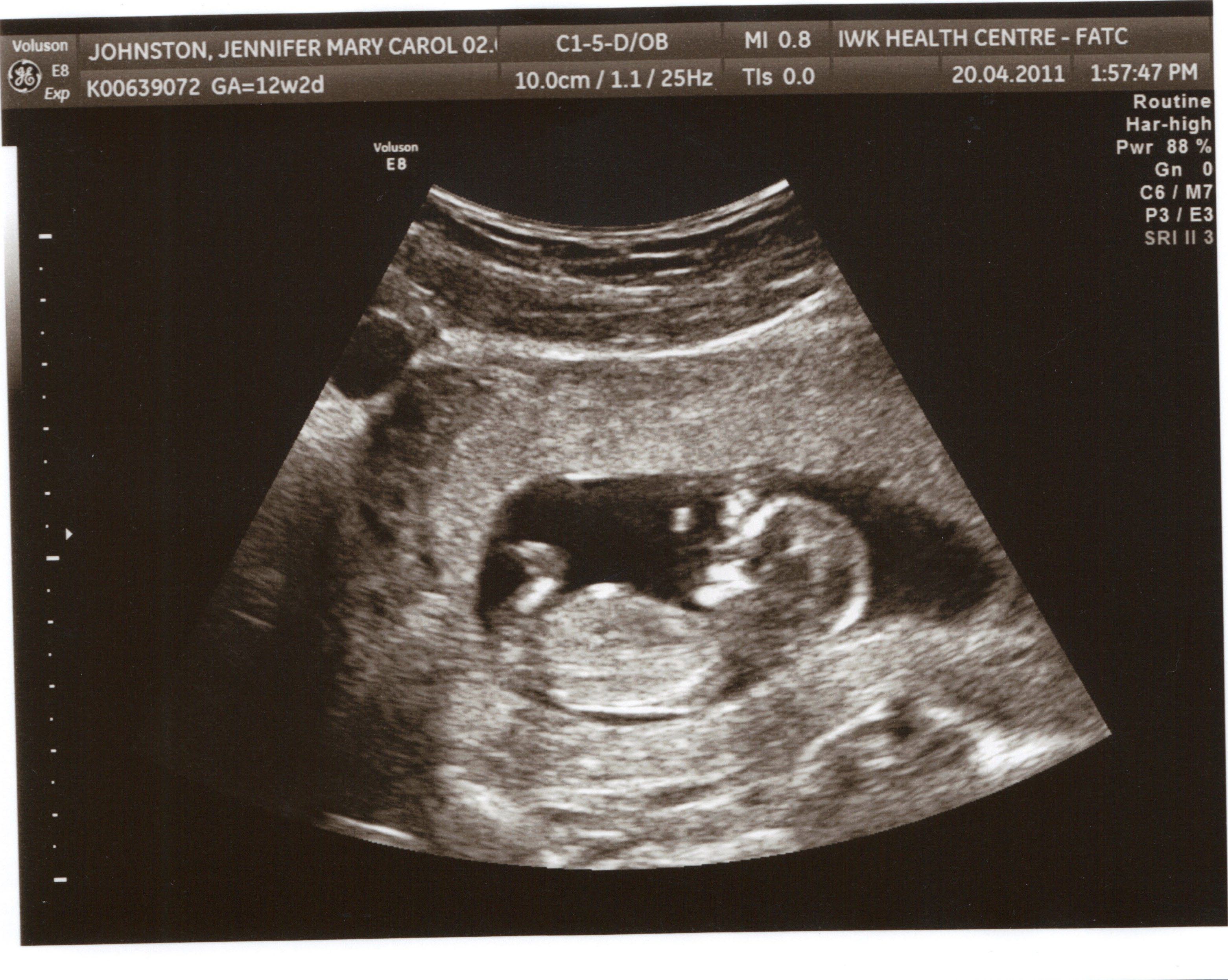 Фото плода в животе на 14 неделе беременности