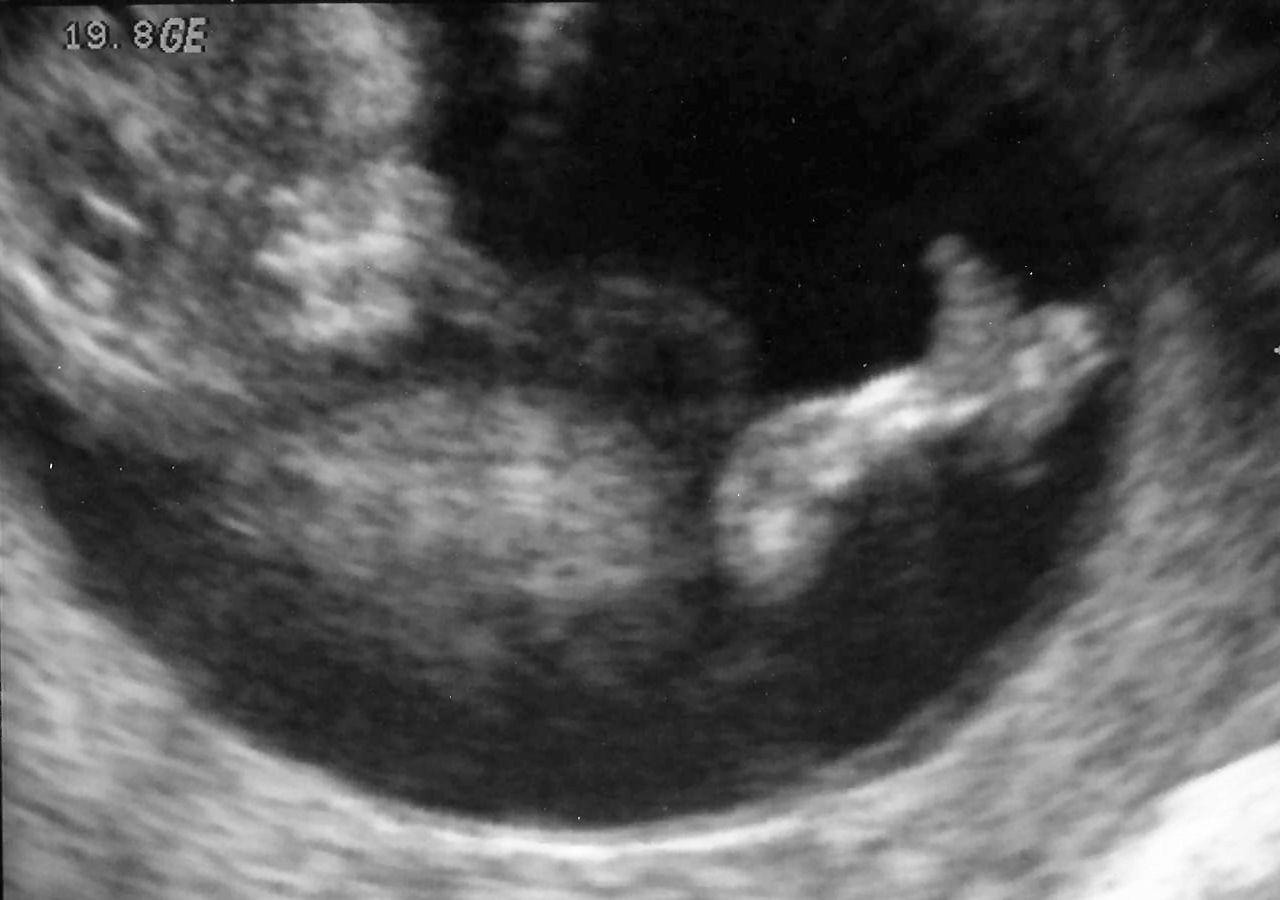 11 недель и 3 дня. УЗИ плода на 11 неделе беременности. Эмбрион на 11 неделе беременности УЗИ. 11 Недель беременности фото плода на УЗИ. УЗИ 11 недель беременности.