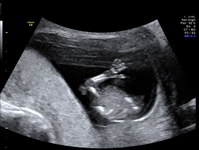 Беременность 15 мм. 13 14 15 16 Неделя беременности УЗИ плода. УЗИ на 14 акушерской неделе беременности.