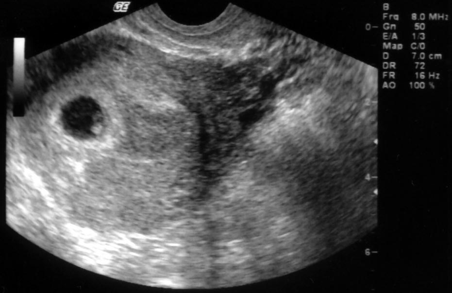 Узи 3 4 недели. Снимки УЗИ беременности.