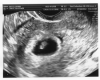 7 неделя беременности: фото живота, УЗИ и вес плода, боли и выделения на 7 неделе