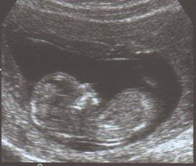 13 недель назад. 13 Недель беременности фото ребенка.