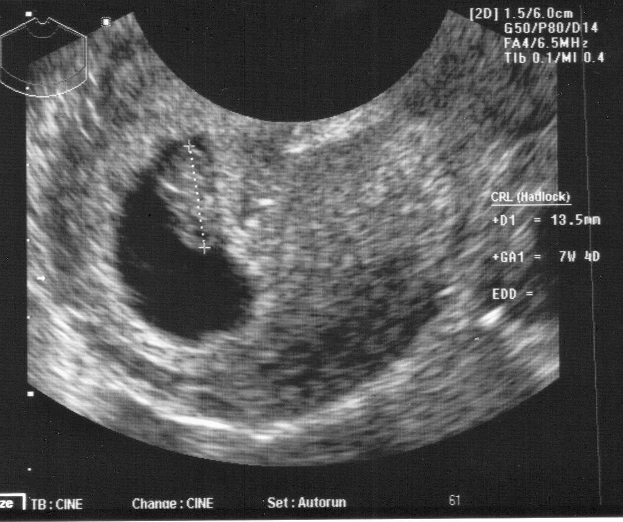 Как выглядит ребенок в 6 7 недель беременности фото