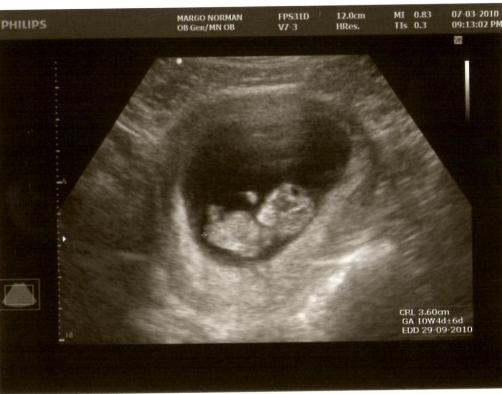 Ребенок в утробе 10 недель фото